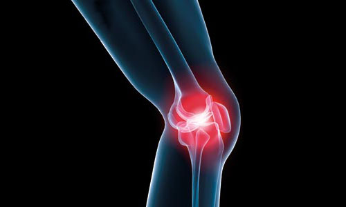 Osteoarthritis (OA)